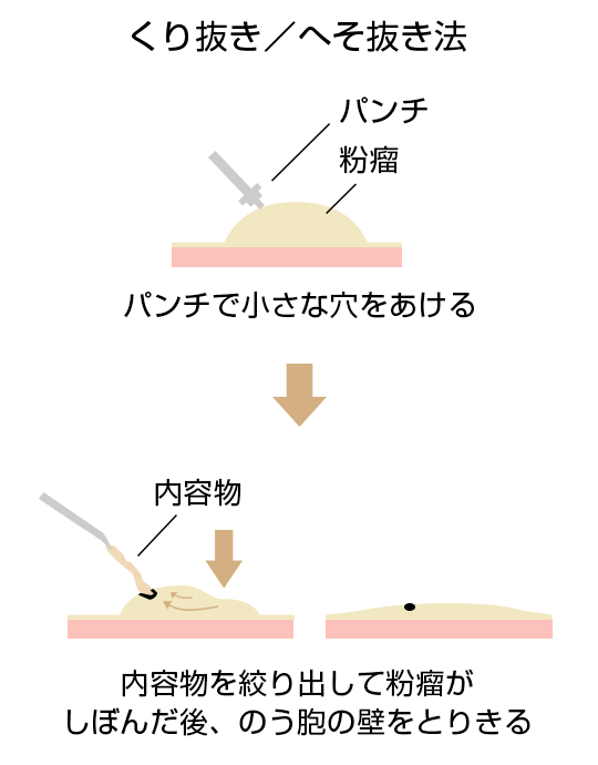 粉瘤の除去 肌と歯のクリニック 千葉 美容皮膚科