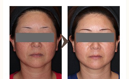 脂肪溶解注射 メソセラピー 肌と歯のクリニック 千葉 美容皮膚科