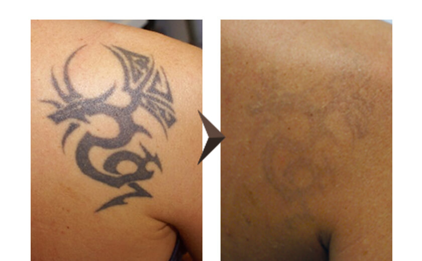 症例写真 ピコレーザーによるタトゥー・刺青除去 40代男性