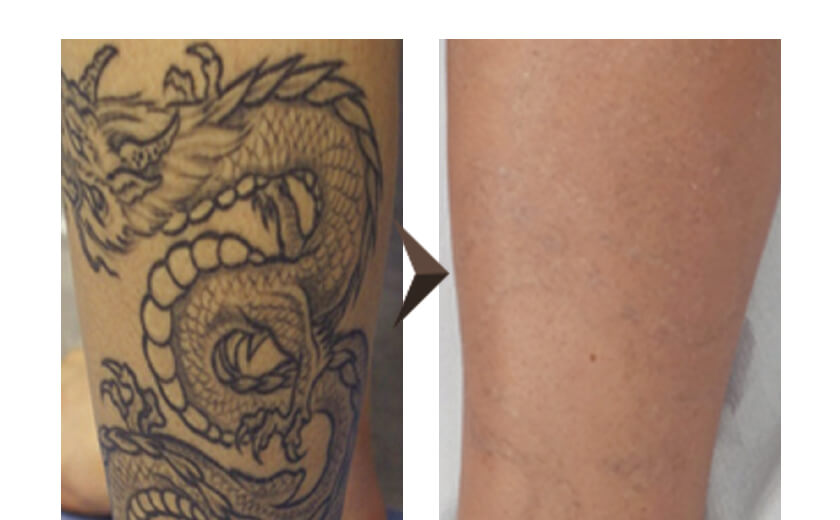 症例写真 ピコレーザーによるタトゥー・刺青除去 40代男性