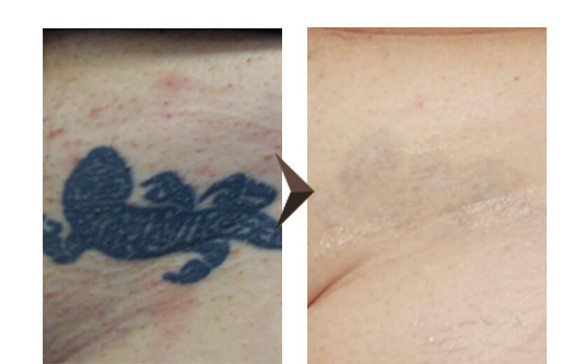 症例写真 ピコレーザーによるタトゥー・刺青除去 40代女性