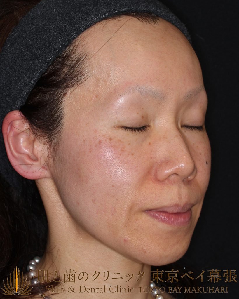 症例写真 しみ治療 アートメイク 眼の周り 鼻 頬にある細かいしみと毛穴を改善されたい40代女性 肌と歯のクリニック 千葉 美容皮膚科