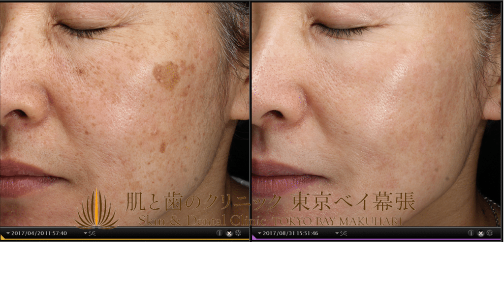 症例写真 しみ治療 しみ半年プランでのしみ複合治療の4か月後 肌と歯のクリニック 千葉 美容皮膚科