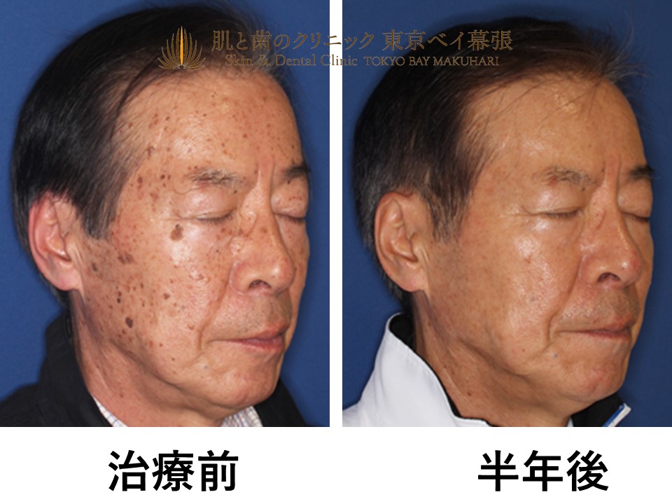 症例写真 しみ治療 男性必見 お顔のイボ 膨らんでいるシミ 脂漏性角化症 を治療 肌と歯のクリニック 千葉 美容皮膚科