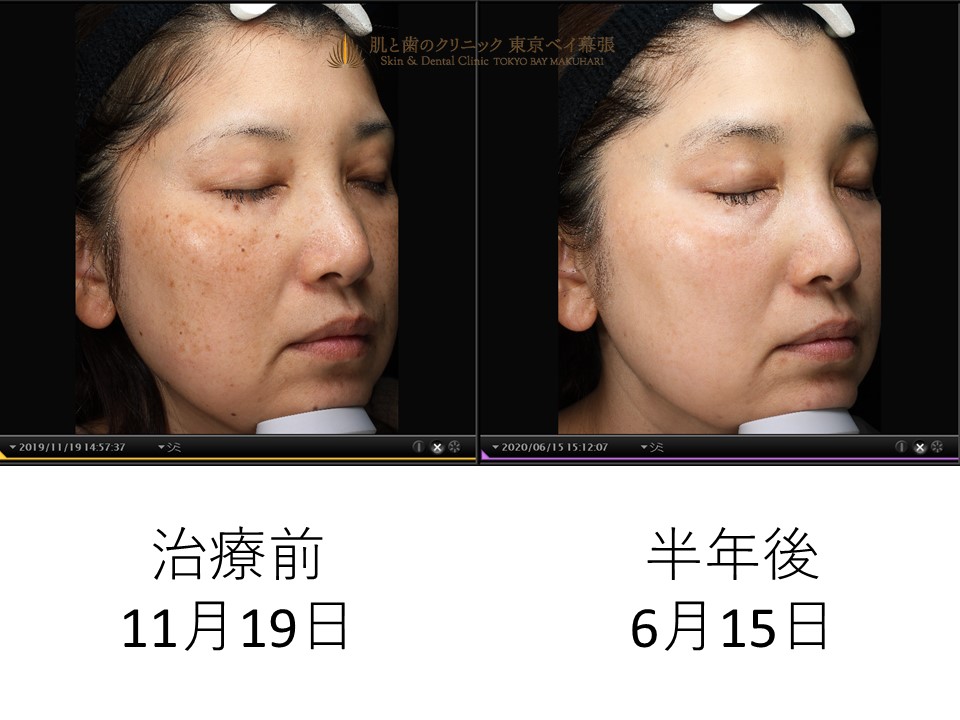 症例写真 両頬のしみ 肝斑 ほくろ混合治療 肌と歯のクリニック 千葉 美容皮膚科