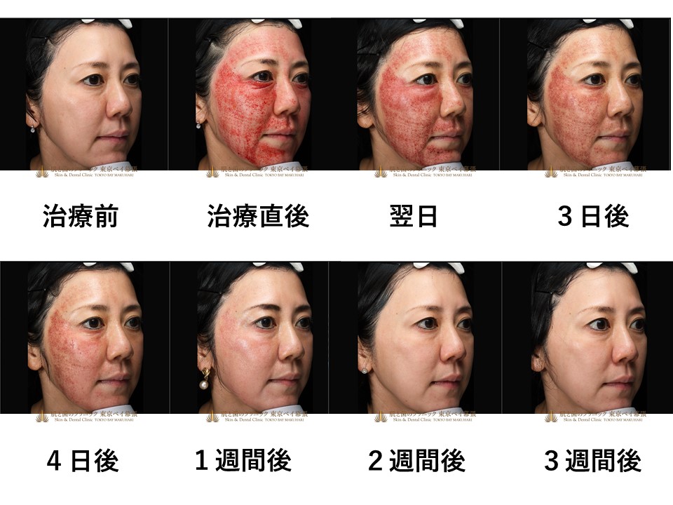 症例写真 ピコフラクショナル お顔全体に治療 ダウンタイムについて 肌と歯のクリニック 千葉 美容皮膚科