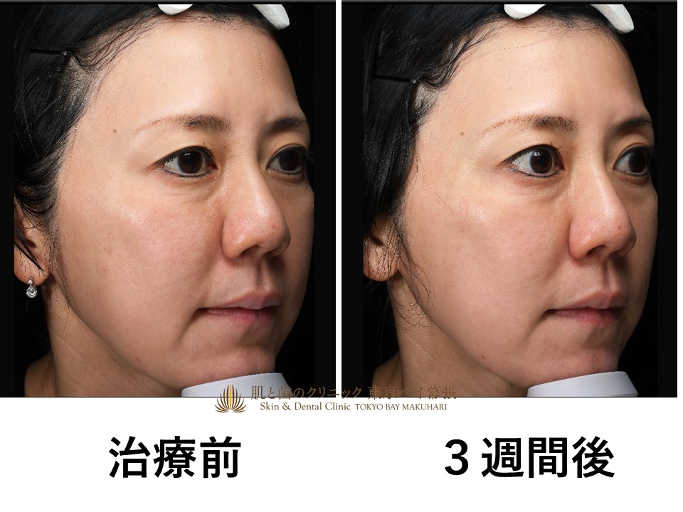 症例写真 ピコフラクショナル お顔全体に治療 ダウンタイムについて 肌と歯のクリニック 千葉 美容皮膚科