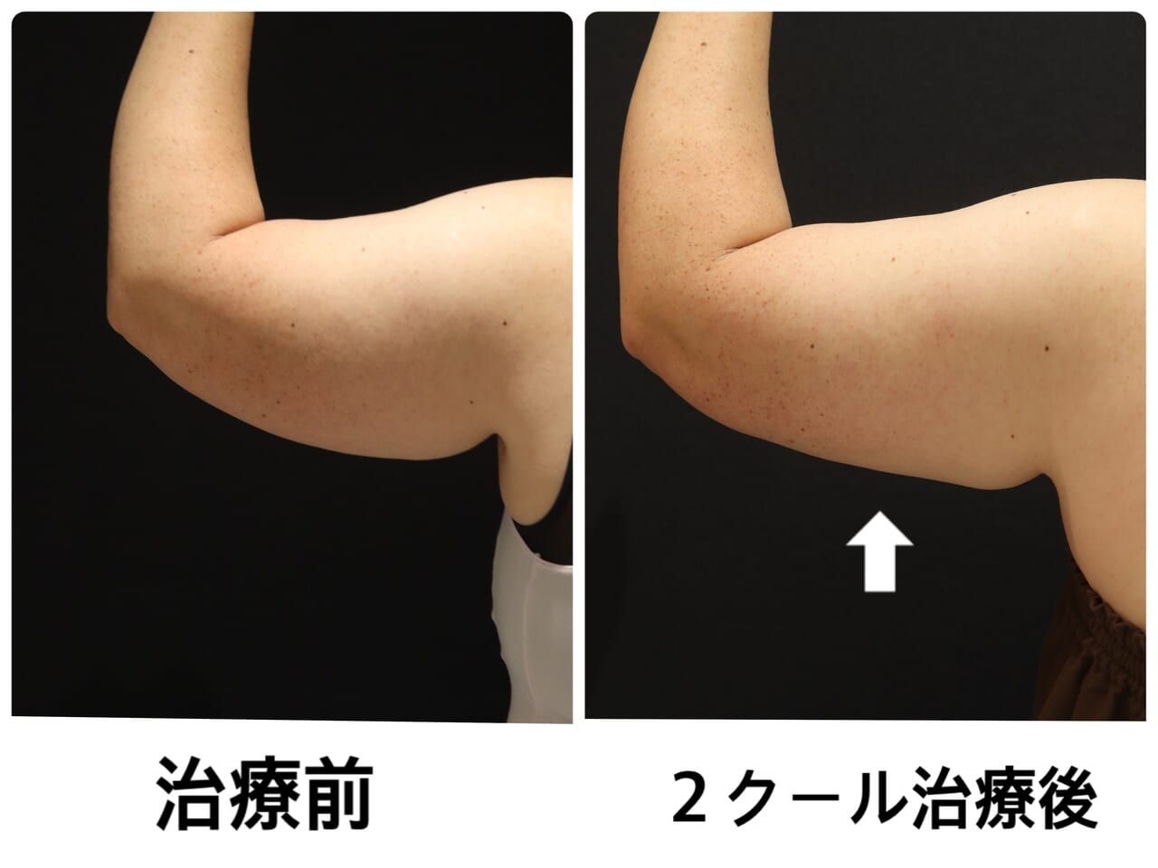 クールスカルプティング