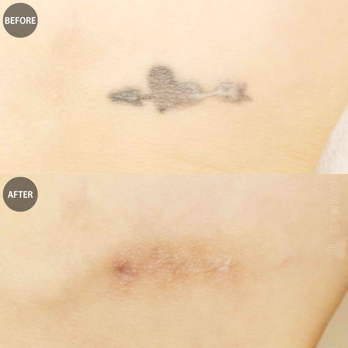 足首のタトゥー除去・治療前と治療後・1年間の経過