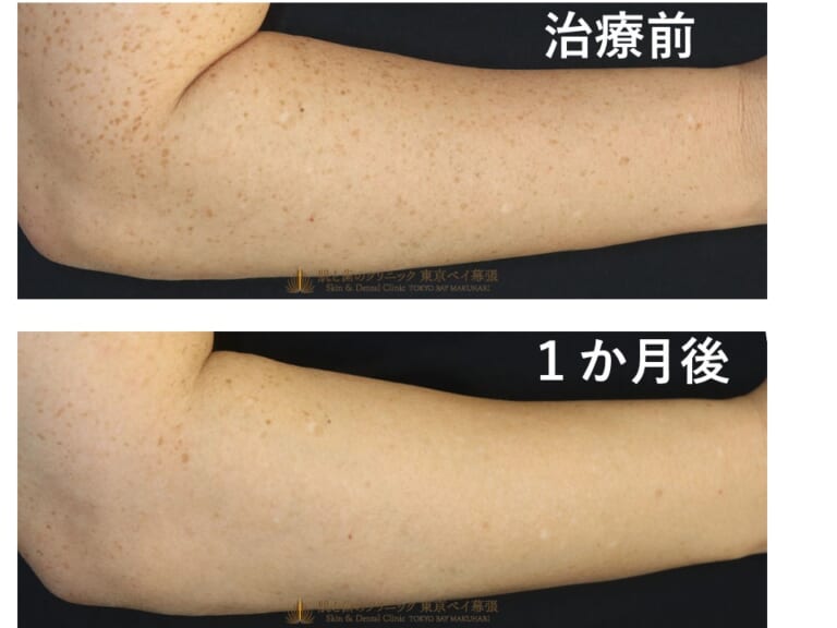 広範囲に広がっていた腕のシミが1回の治療で激減【治療経過の症例その5】 | 肌と歯のクリニック 東京ベイ幕張 (千葉 美容皮膚科)