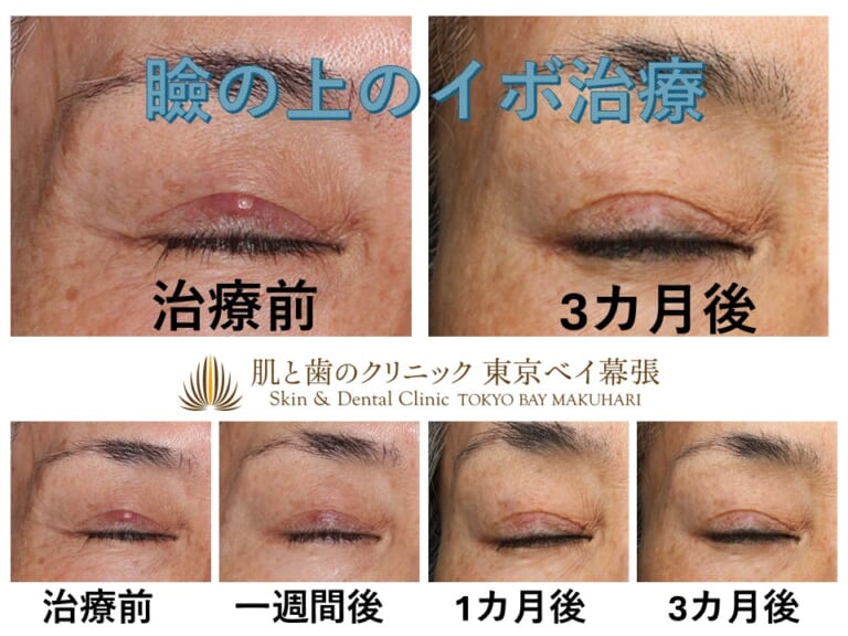 目の際や眼のふちの「できもの」「いぼ」「稗粒腫」でお悩みの方・モニター募集 | 肌と歯のクリニック 東京ベイ幕張 (千葉 美容皮膚科)