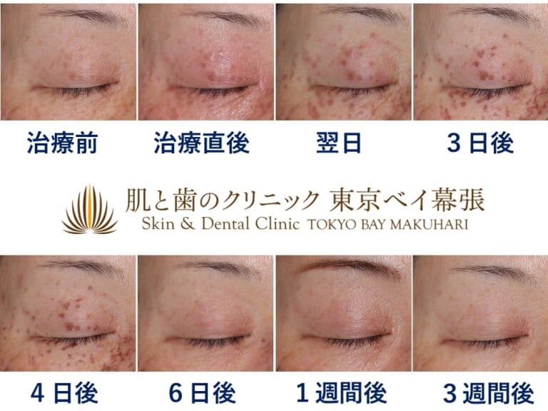 症例写真 | 目元のシミにお悩みの方へ朗報！目周り・瞼のシミ取り放題プランをご紹介 | 肌と歯のクリニック 東京ベイ幕張 (千葉 美容皮膚科)