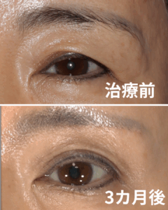 加齢による瞼のたるみ・目が小さくなった気がする・・・眉毛下皮膚切除症例